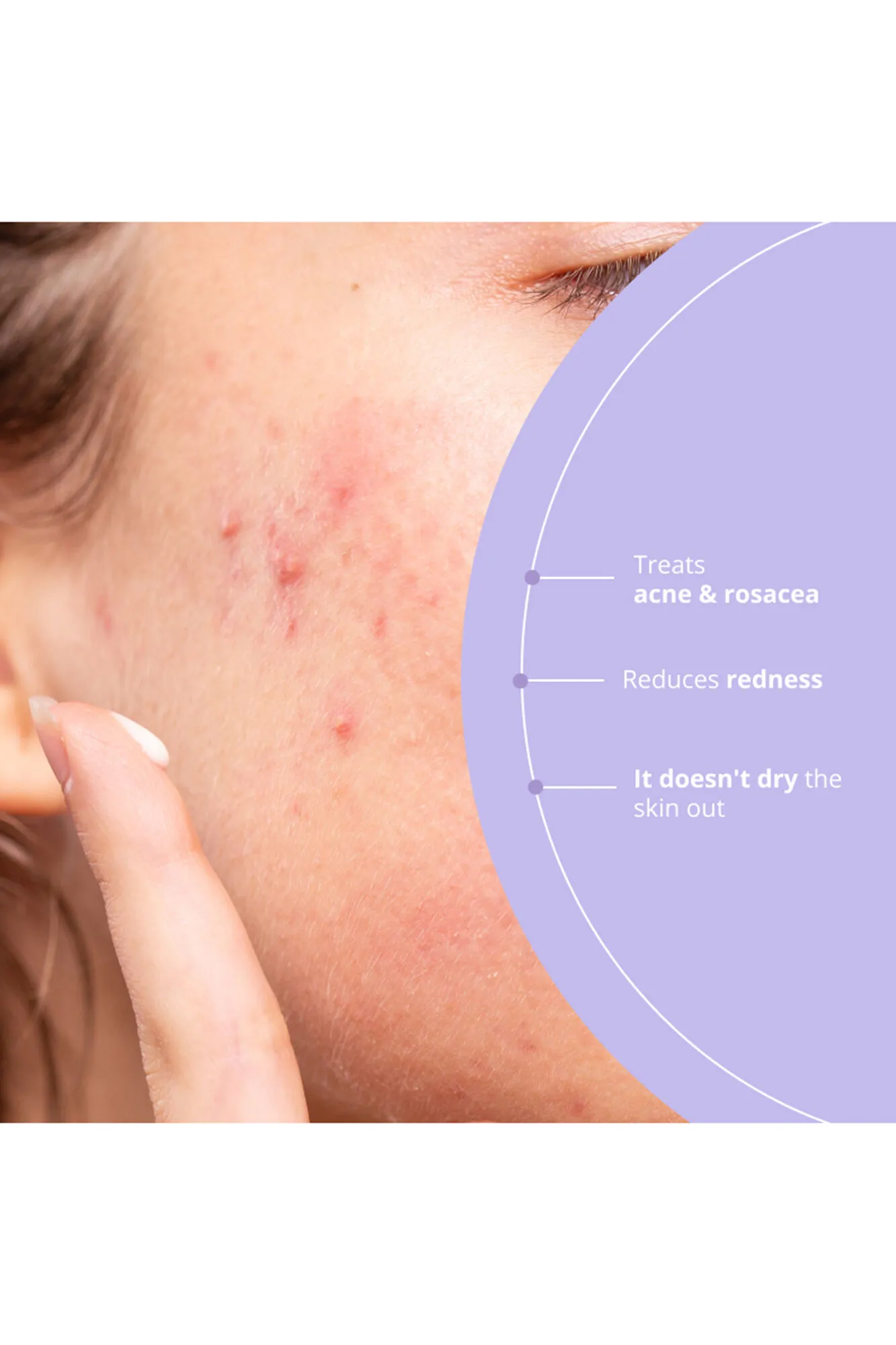 Azelaic Radiance Tratamiento facial